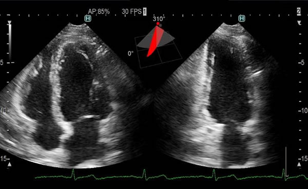 [画像]3D経胸壁マトリックスプローブによる心臓の2断面同時表示