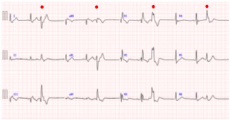 [画像]図1 心電図にて記録された心室期外収縮(赤丸印)。生体内の導電率は臓器により不均一であるため、心電図で計測される信号はゆがみをもちます。その一方で生体内の透磁率は均一とみなせるため、心磁図で計測される信号は他の臓器に影響されません。