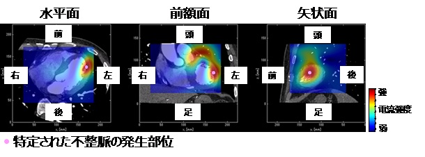 [画像]図2 臓に流れる電流の3次元分布画像(心磁図)と心臓CT画像の合成画像。カラーマップは心磁図に対応しており、赤い領域は電流が強い領域です。