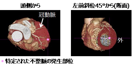 [画像]図3 心臓の3次元モデル上で特定された不整脈の発生部位。不整脈の発生部位が心臓の内側に特定されています。