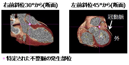 [画像]図4 心臓の3次元モデル上で特定された不整脈の発生部位。不整脈の発生部位が心臓の外側に特定されています。