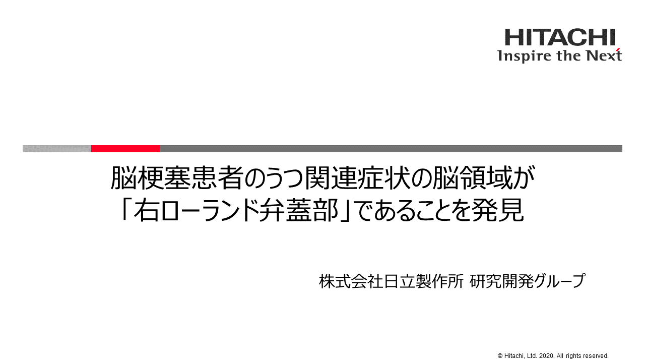 資料(動画)：脳梗塞患者のうつ関連症状の脳領域が「右ローランド弁蓋部」であることを発見